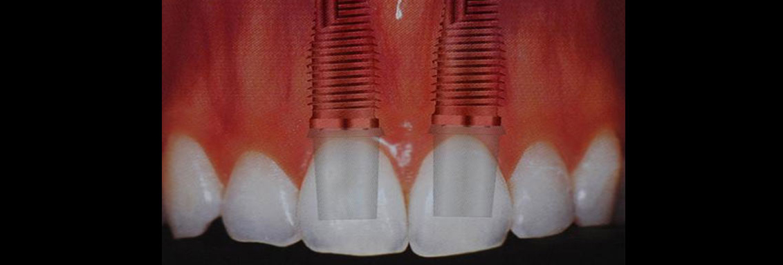 implantes dentários