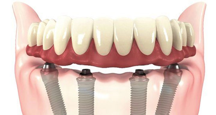 implantes dentários